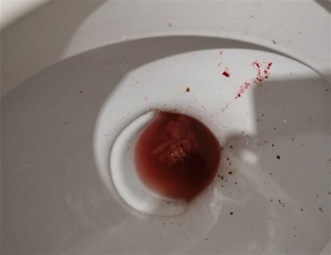 Do Fissures Bleed Severely Warning Pic Anal Fissure And Proctalgia