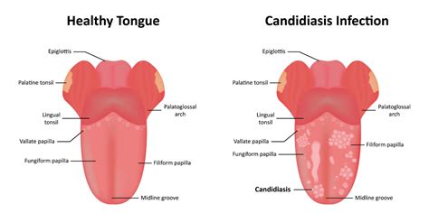 Candidiasis Bucal Causas Síntomas Y Tratamiento Teeth 22
