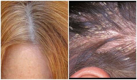 How To Treat Itchy Scalp Medical Overview And Treatments