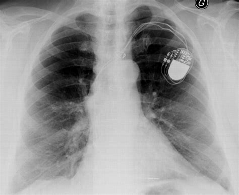 Chest Pain Due To Severe Sternal Pseudoarthrosis Post Coronary Artery