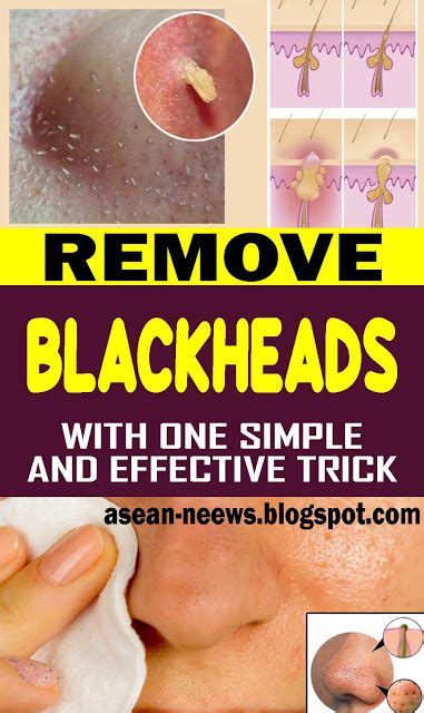 Remove Blackheads With One Simple And Effective Trick