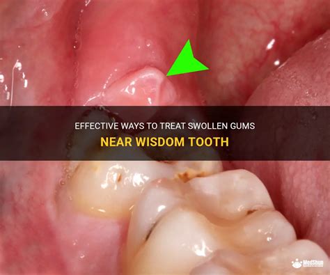 Effective Ways To Treat Swollen Gums Near Wisdom Tooth Medshun