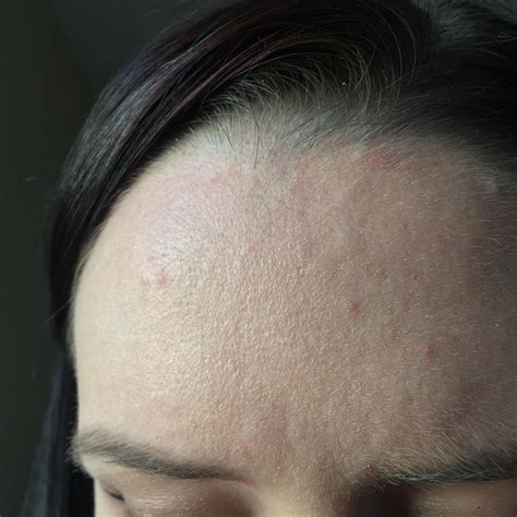 Skin Concerns Dry Flaky Forehead And Pimples That Sometimes Burn Or Itch Rskincareaddiction