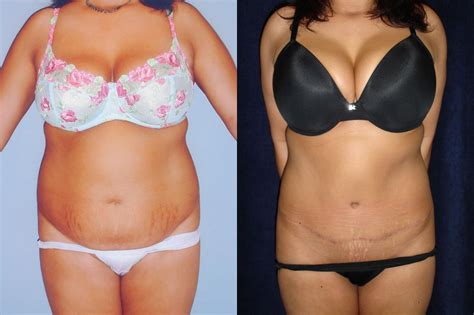 Tummy Tuck Before After Photos Patient 67 San Francisco CA