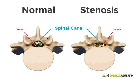 Spinal Stenosis What Causes Narrowing Of Your Spine Or Backbone Free