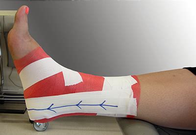 Check spelling or type a new query. How to Tape an Ankle | FootCareMD