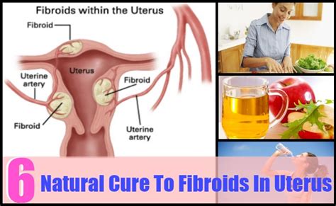 How to shrink uterine fibroids naturally with healthy nutrition. My Fibroid Tumor Natural Remedy - Shrink Fibroids ...