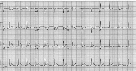 Rituximab Induced Acute St Elevation Myocardial Infarction Ochsner