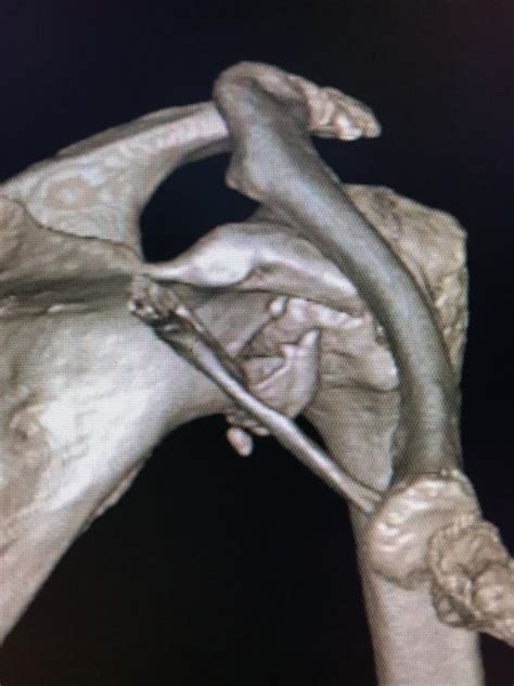 Complex Shoulder Instability Arthroscopic Treatment Of Glenoid