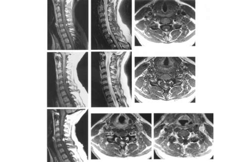 Serial Images Obtained Through The Cervical Spine In A Patient During A