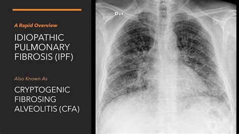 Idiopathic Pumonary Fibrosis A Rapid Overview Pathophysiology Diagnosis And Management Of Ipf