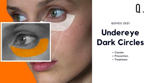 How To Correctly Fix Dark Undereye Circles Causes Prevention And