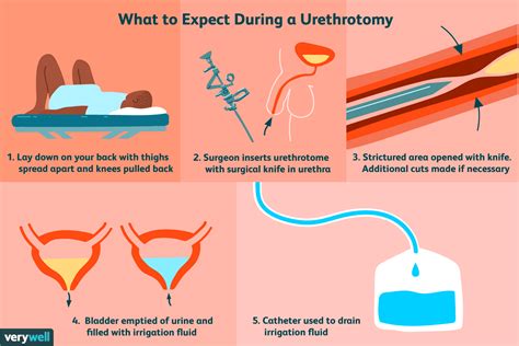 What Is A Urethrotomy And Why Is It Important