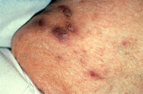 Boils On Patients Thigh Stock Image C0222128 Science Photo Library