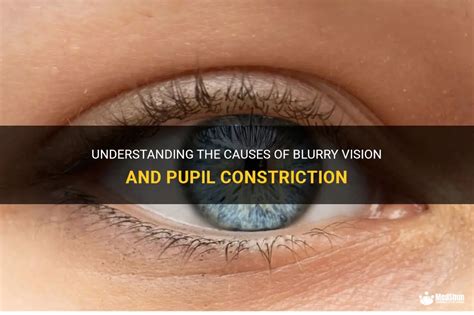 Understanding The Causes Of Blurry Vision And Pupil Constriction Medshun