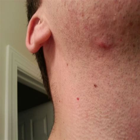 Top 92 Images Itchy Bumps On Scalp Pictures Updated