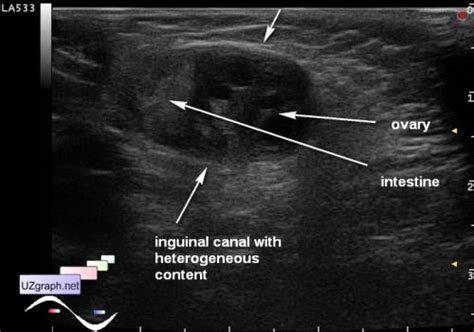 Abdomen Sonography Strangulated Inguinal Hernia Clinical Report