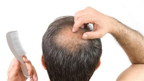 How To Cure Baldness Naturally Fitnhealthyu