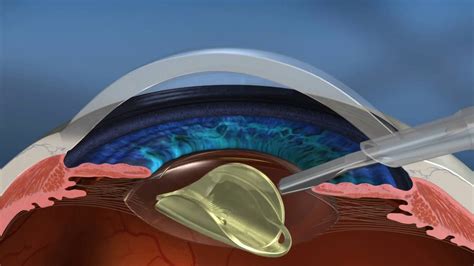 Lensxr Laser Cataract Surgery Youtube