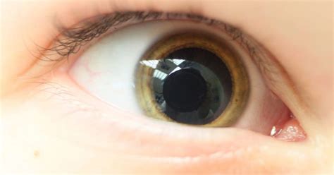 Mydriasis Causes And Treatment For Dilated Pupils