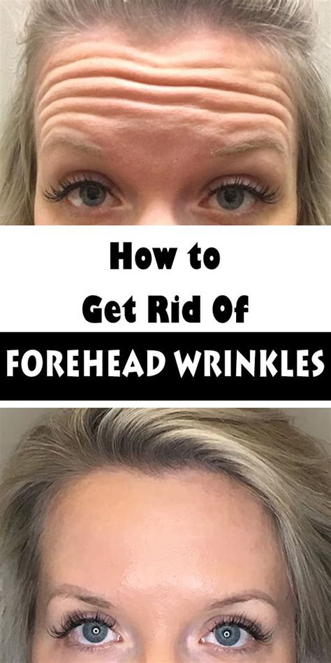 How To Get Rid Of Forehead Wrinkles Without Botox Healthcare Topic
