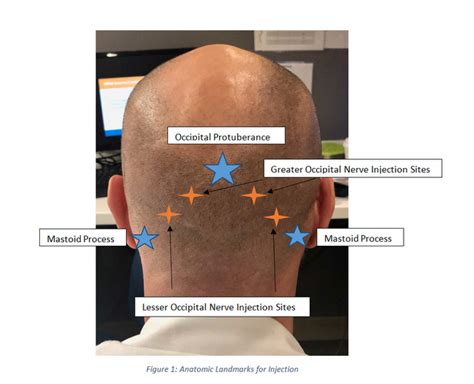 Occipital Nerve Block Injection