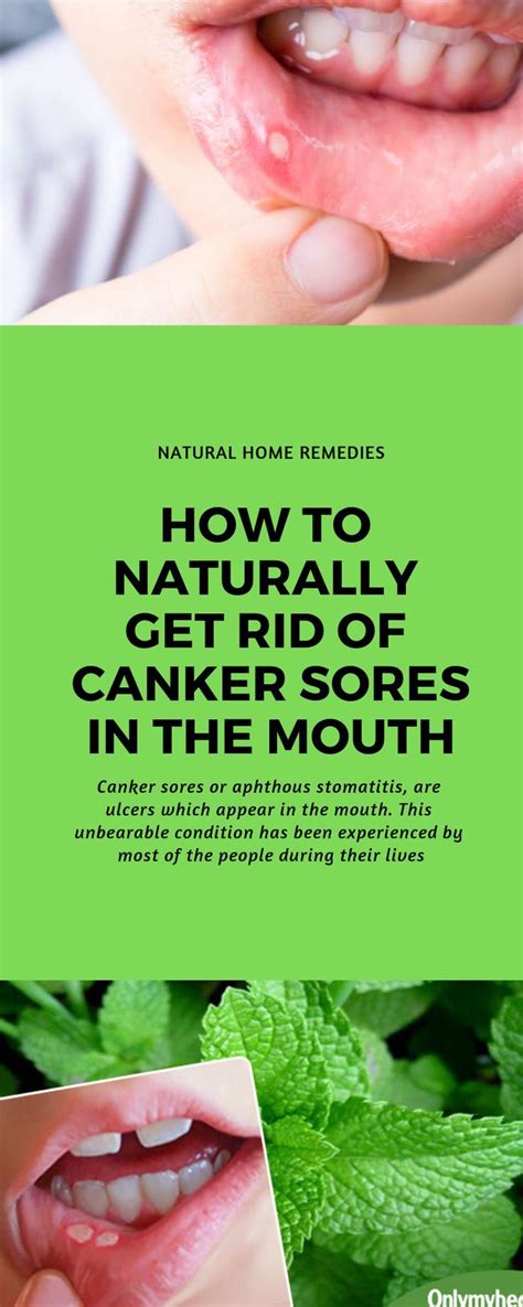 How To Cure Canker Sores At Home