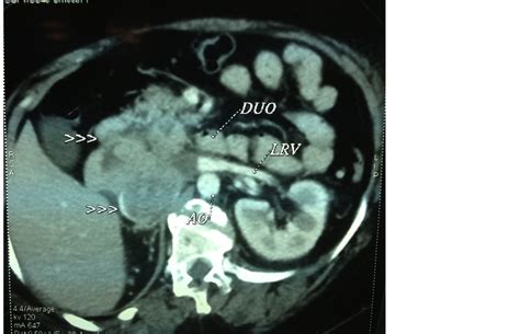 A Rare Retroperitoneal Mass Leiomyosarcoma Of The Inferior Vena Cava
