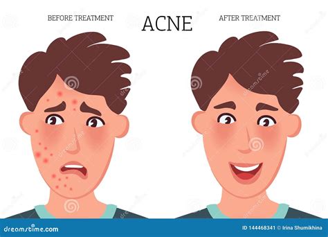 Teenager With Acne And Acne On The Face Before And After Treatment