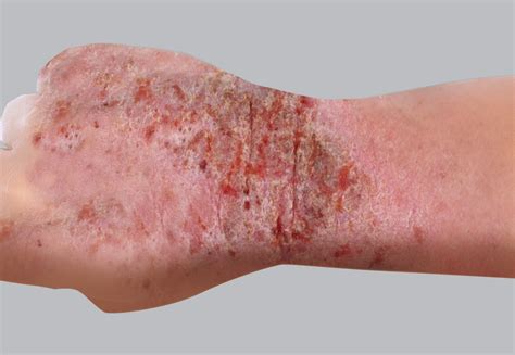 Everything You Need To Know About Eczema Atopic Dermatitis With My