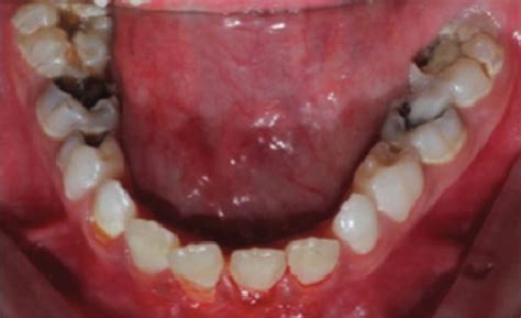 Intraoral Preoperative Photographs Showing A Maxillary Occlusal View
