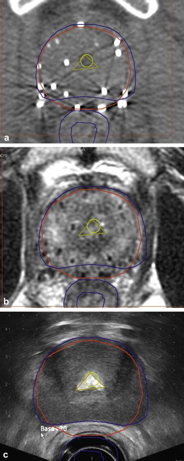 Transverse Midgland Images Showing Prostate Contours From Transrectal