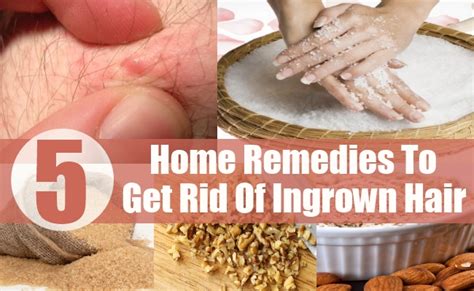Also, it removes impurities that could block the hair follicles and worsen the irritation. 5 Top Home Remedies To Get Rid Of Ingrown Hair | DIY ...