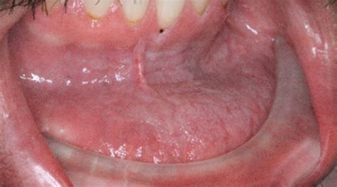 Diagnosis And Treatment For Breakthrough Clinical Oral Pathology Case