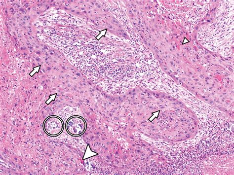 Squamous Cell Carcinoma Of The Bladder Complicating Schistosomiasis