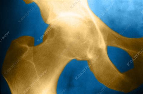 Osteoarthritis Of The Hip X Ray Stock Image C0252783 Science
