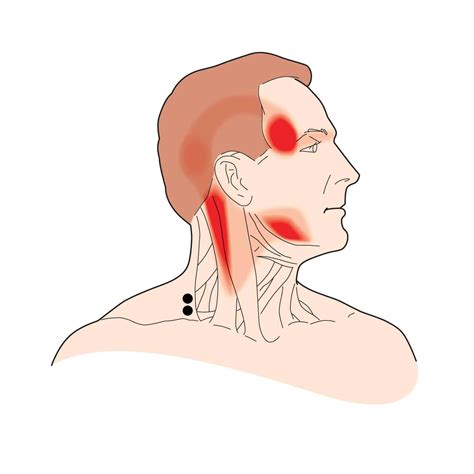 Muscle Knots In Head Neck Tigertailusa