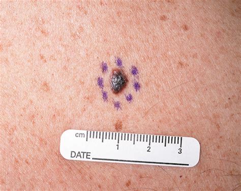 Malignant Melanoma Photograph By National Cancer Institutescience