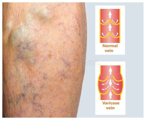 Varicose Veins On A Female Senior Leg Stock Photo Image Of Problem