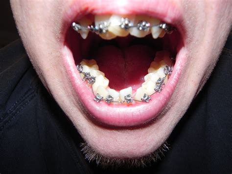 How Long To Wear Retainers After Braces