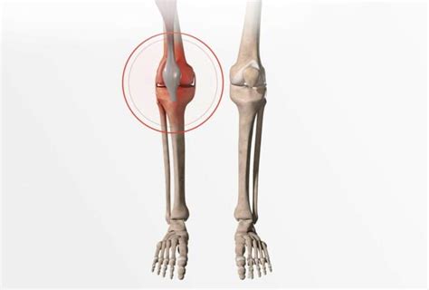 Définition symptômes et diagnostic de la fracture du genou Dr Paillard