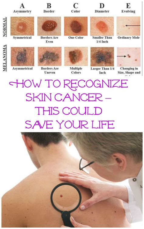 How Do You Identify Skin Cancer Spots