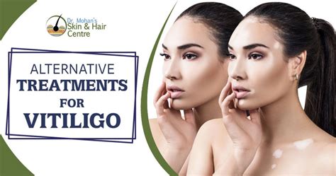 Alternative Treatments Available For Vitiligo