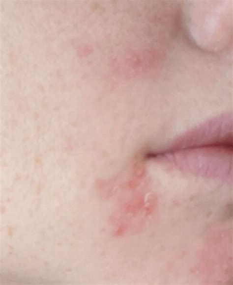 Help Dry But Spotty Patches On Face Mumsnet