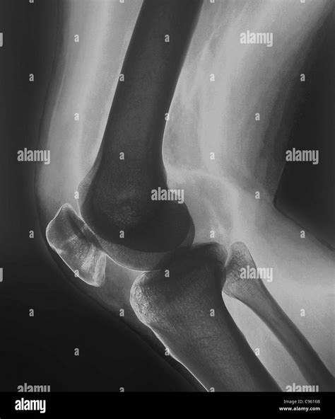 Broken Knee X Ray Of The Knee Of A 38 Year Old Patient With A