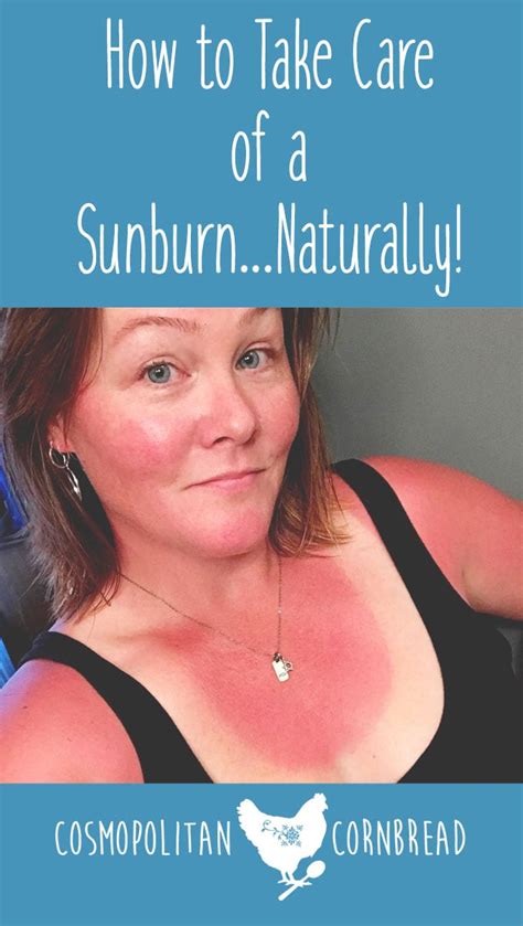 How To Take Care Of A Sunburn Naturally A Good Life Farm