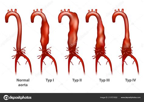 Dissecting Abdominal Aortic Aneurysm