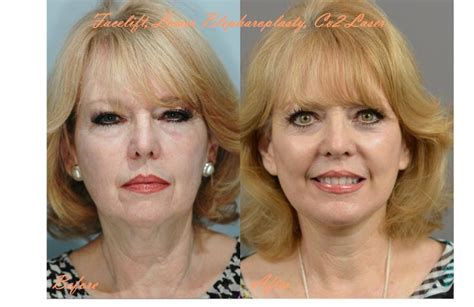 Facial Rejuvenation Surgery Facial Rejuvenation Rejuvenation Facial