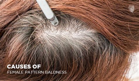 Female Pattern Baldness Symptoms Causes Treatment And Prevention
