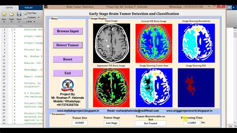 Matlab Code For Brain Tumor Detection Using Segmentation Youtube